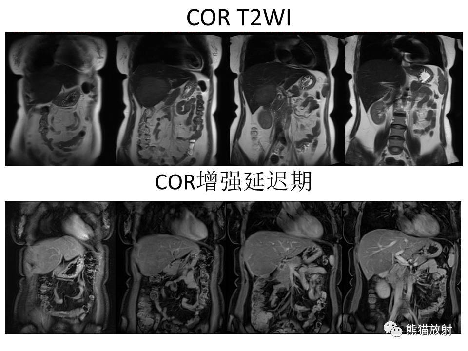 影像PPT - 【病例】肝细胞腺瘤2例MR影像-26