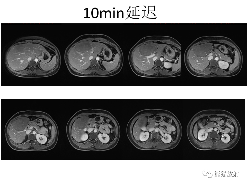 影像PPT - 【病例】肝细胞腺瘤2例MR影像-24