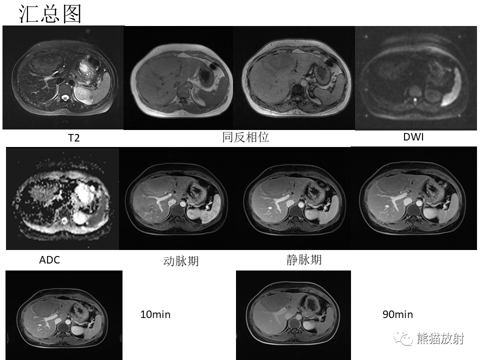 影像PPT - 【病例】肝细胞腺瘤2例MR影像-27