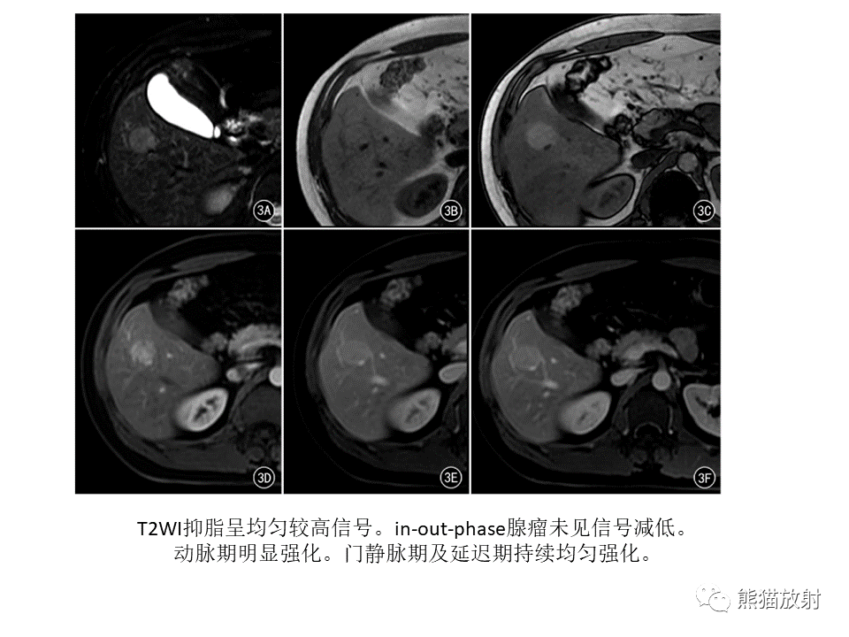 影像PPT - 【病例】肝细胞腺瘤2例MR影像-37