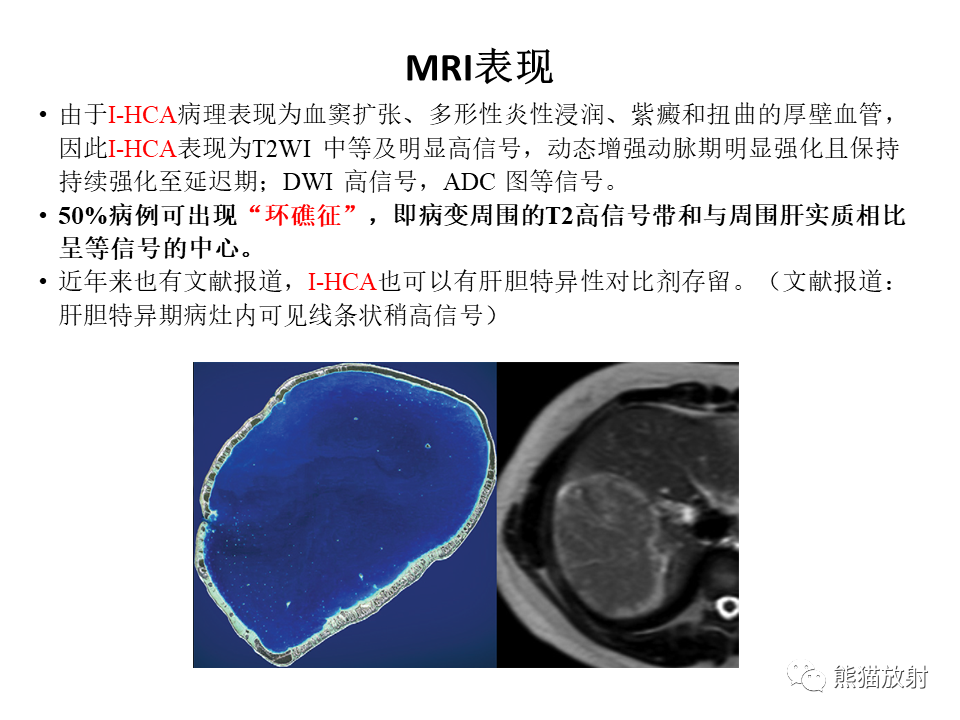 影像PPT - 【病例】肝细胞腺瘤2例MR影像-36