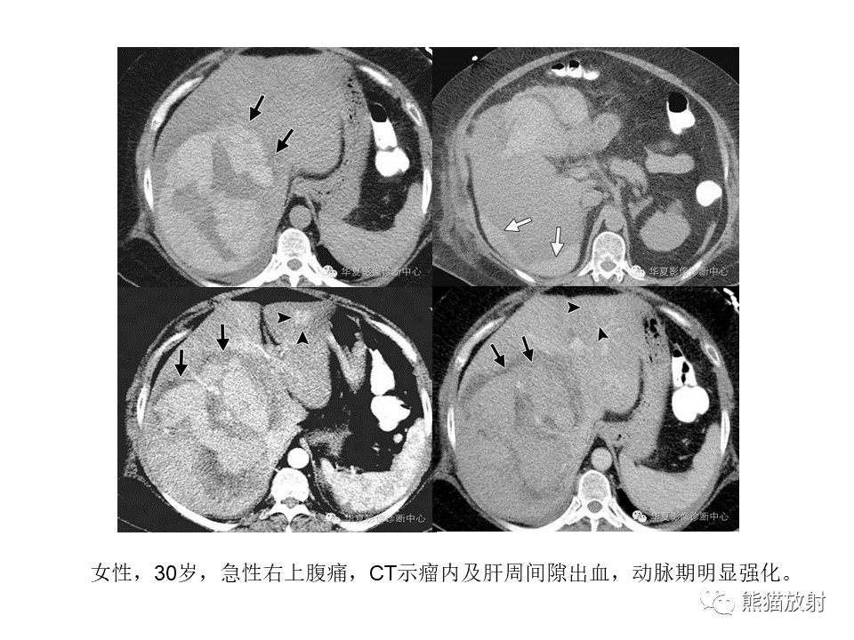 影像PPT - 【病例】肝细胞腺瘤2例MR影像-38