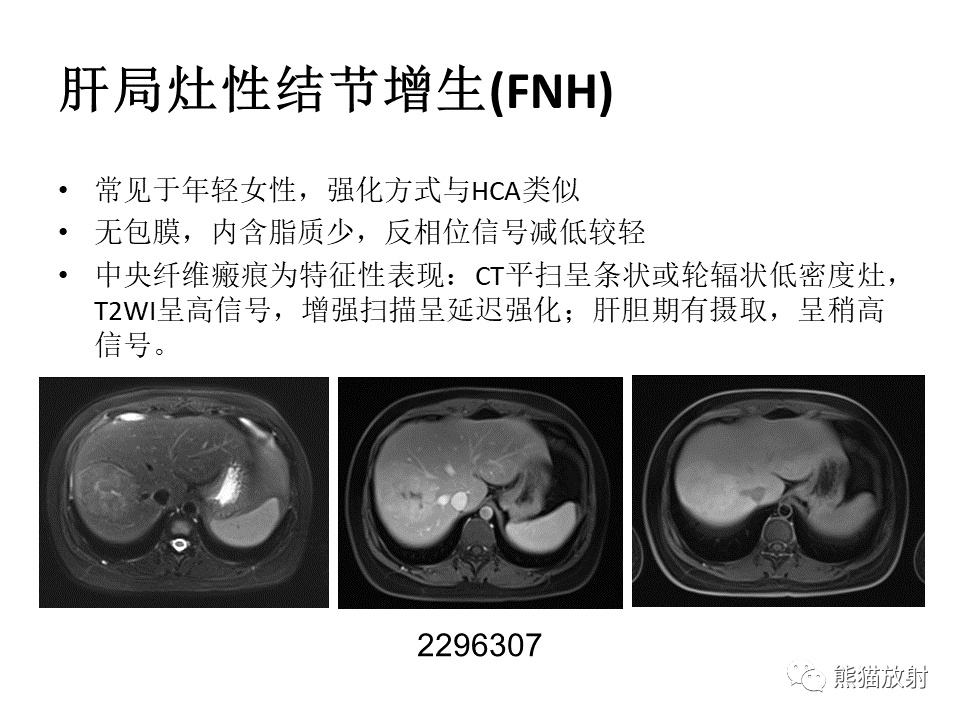 影像PPT - 【病例】肝细胞腺瘤2例MR影像-47