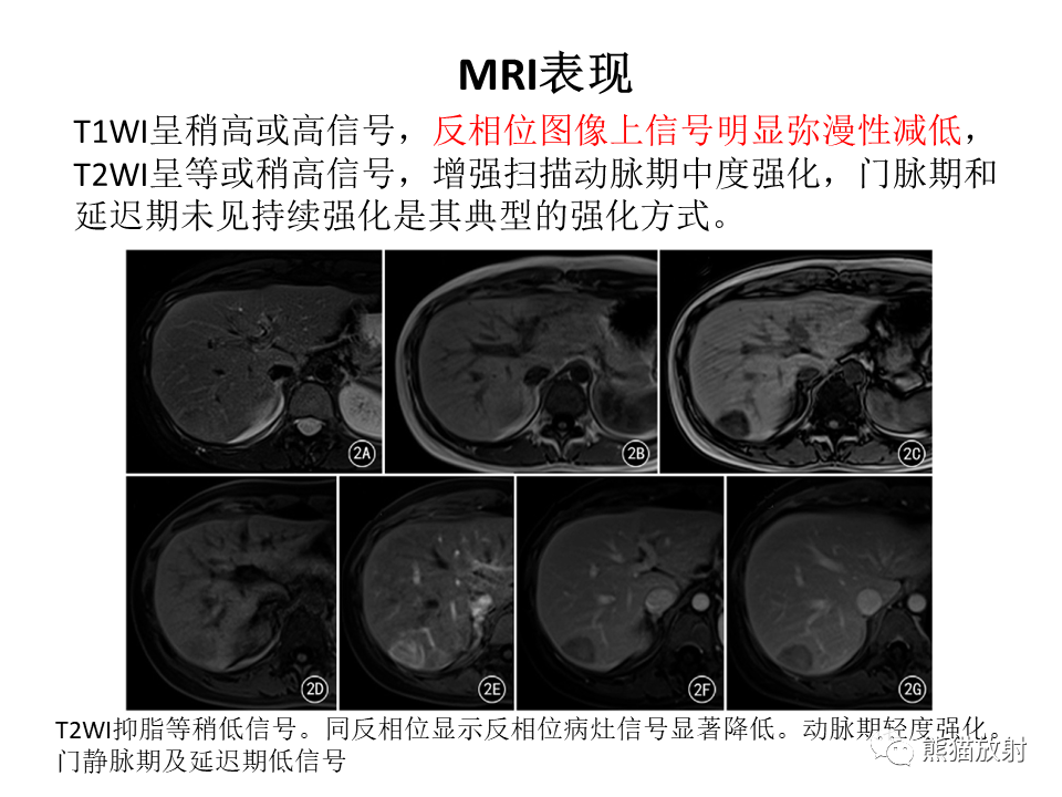 影像PPT - 【病例】肝细胞腺瘤2例MR影像-41