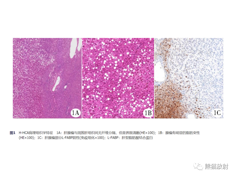 影像PPT - 【病例】肝细胞腺瘤2例MR影像-40