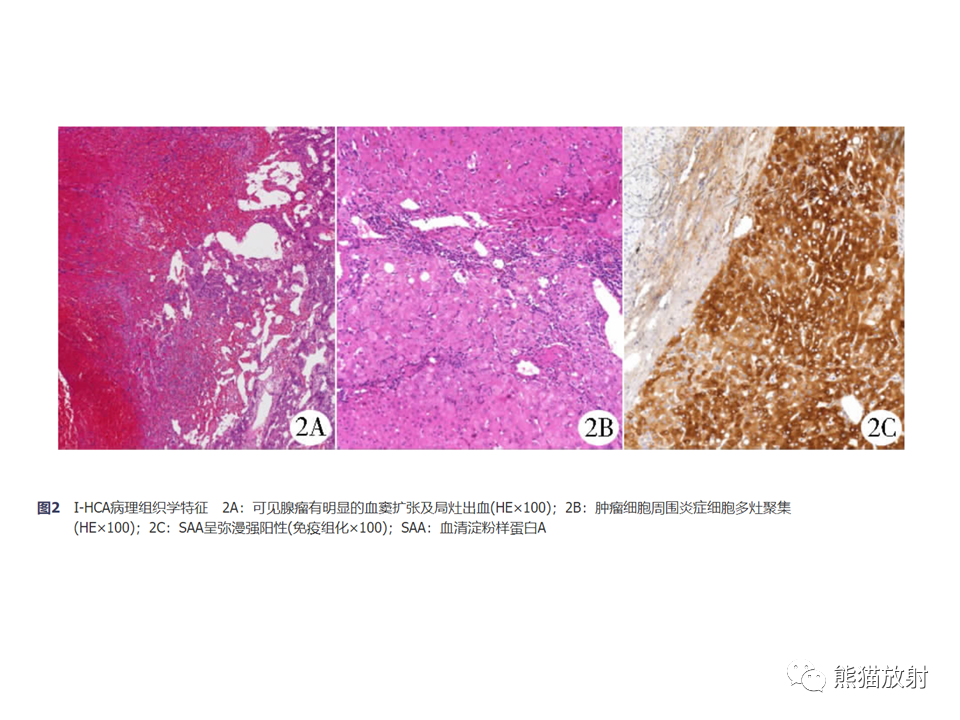 影像PPT - 【病例】肝细胞腺瘤2例MR影像-35