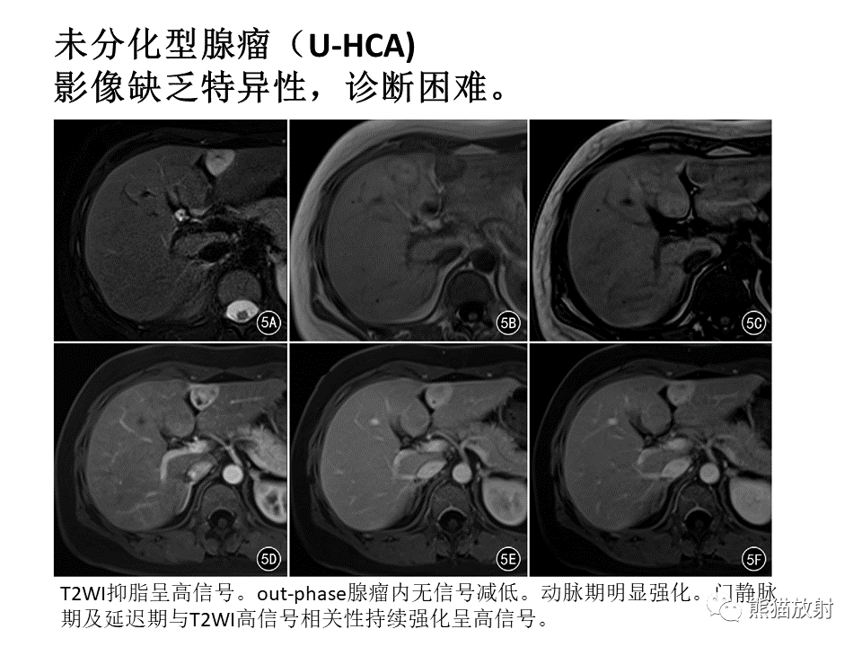 影像PPT - 【病例】肝细胞腺瘤2例MR影像-45