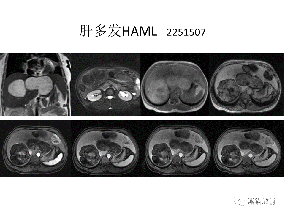 影像PPT - 【病例】肝细胞腺瘤2例MR影像-49
