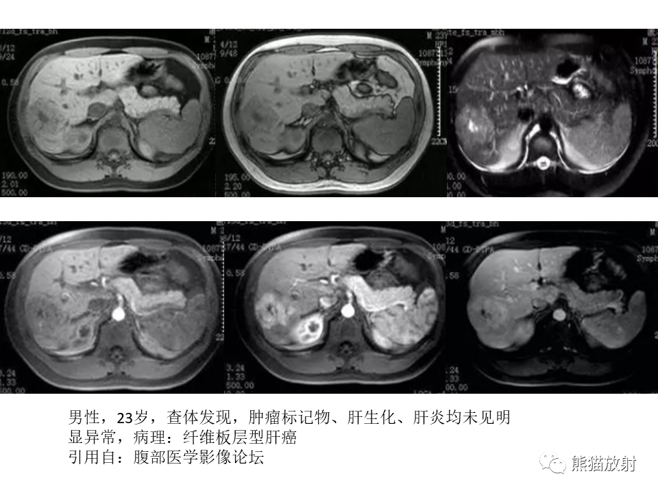 影像PPT - 【病例】肝细胞腺瘤2例MR影像-51