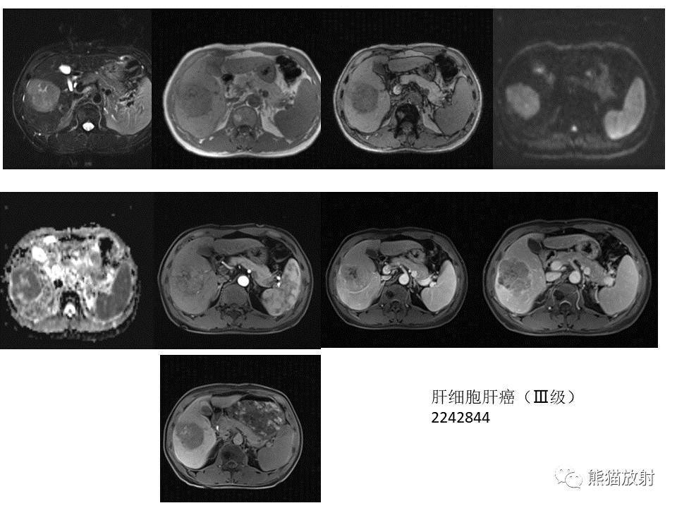 影像PPT - 【病例】肝细胞腺瘤2例MR影像-53