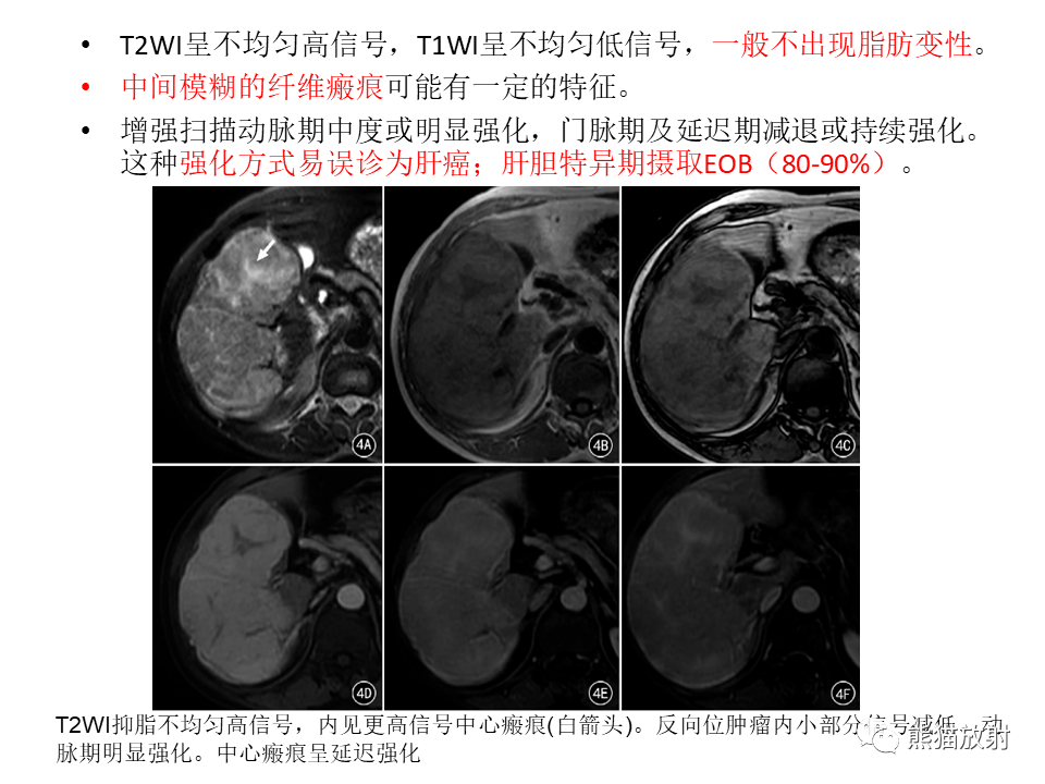 影像PPT - 【病例】肝细胞腺瘤2例MR影像-44