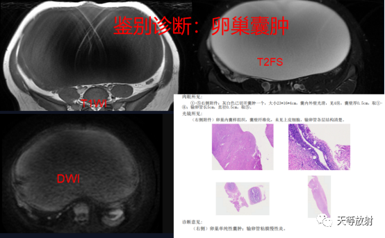 影像PPT - 【病例】卵巢性索间质肿瘤—卵泡膜细胞纤维瘤1例MR-17 影像PPT - 【病例】卵巢性索间质肿瘤—卵泡膜细胞纤维瘤1例MR-17
