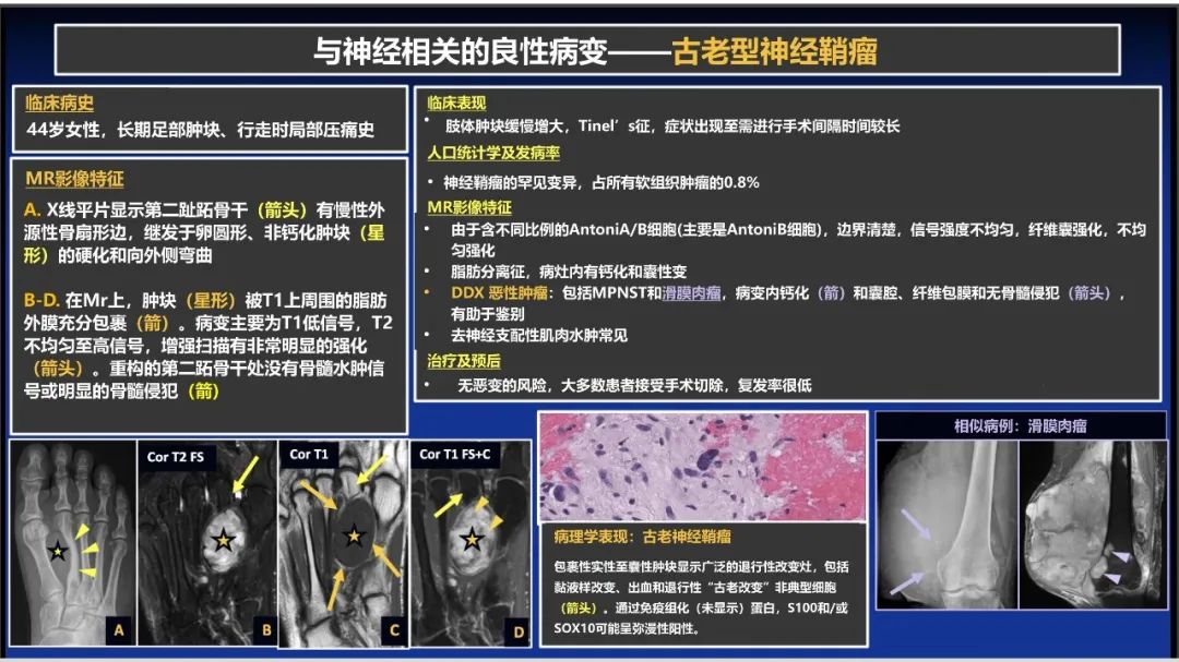 影像PPT - 【PPT】除了神经鞘瘤和神经纤维瘤：与神经相关的良性和恶性病变综述-7