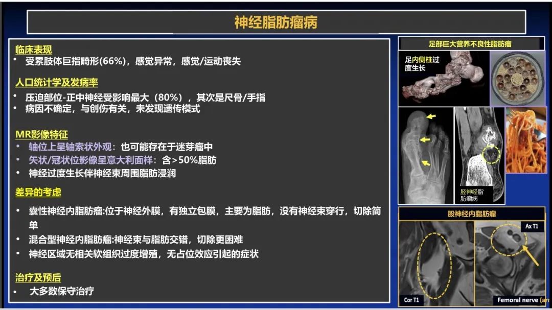 影像PPT - 【PPT】除了神经鞘瘤和神经纤维瘤：与神经相关的良性和恶性病变综述-5