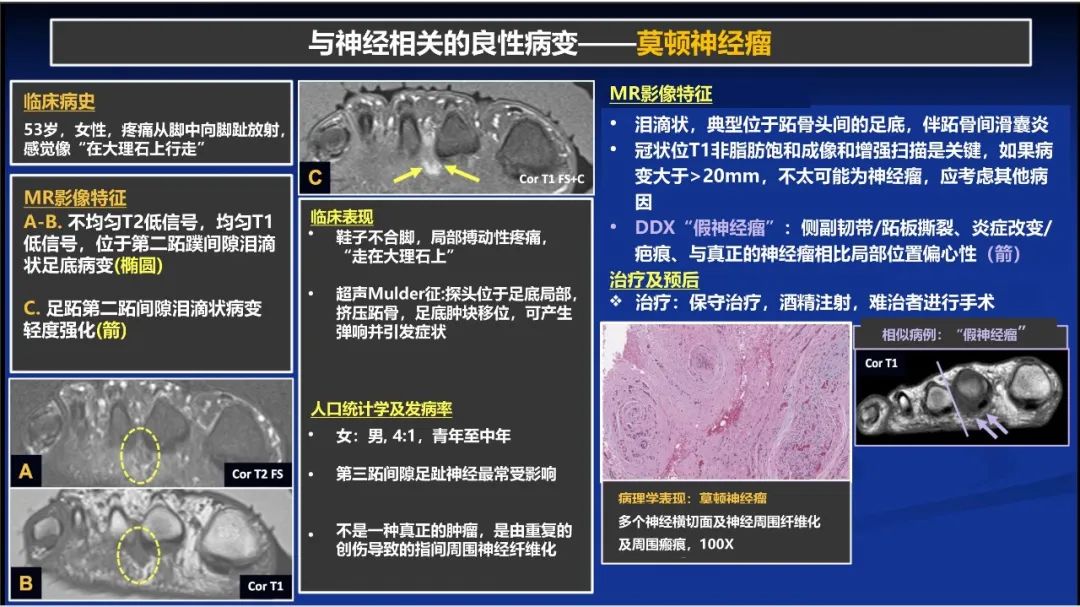 影像PPT - 【PPT】除了神经鞘瘤和神经纤维瘤：与神经相关的良性和恶性病变综述-1