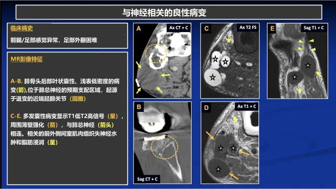 影像PPT - 【PPT】除了神经鞘瘤和神经纤维瘤：与神经相关的良性和恶性病变综述-9