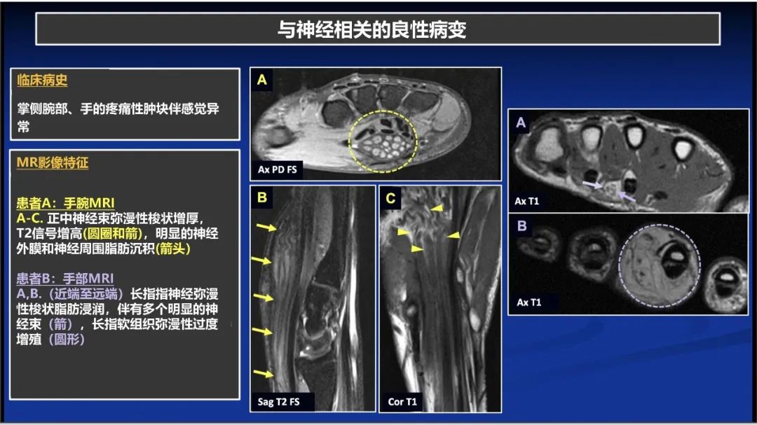 影像PPT - 【PPT】除了神经鞘瘤和神经纤维瘤：与神经相关的良性和恶性病变综述-3