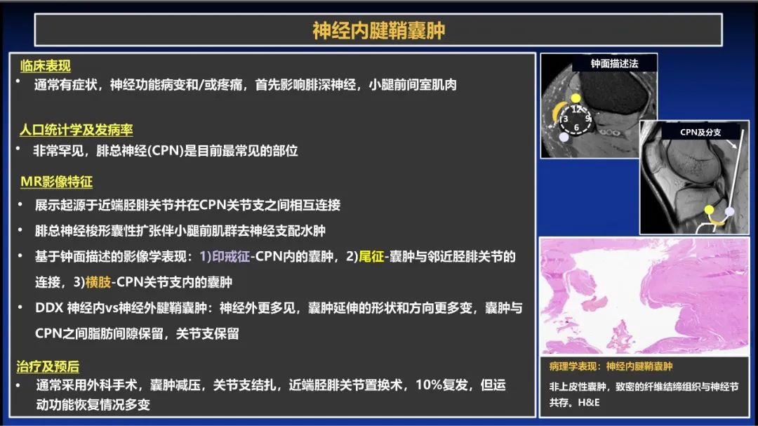 影像PPT - 【PPT】除了神经鞘瘤和神经纤维瘤：与神经相关的良性和恶性病变综述-11