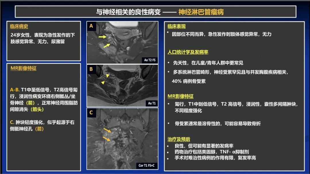 影像PPT - 【PPT】除了神经鞘瘤和神经纤维瘤：与神经相关的良性和恶性病变综述-13