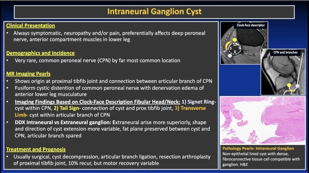影像PPT - 【PPT】除了神经鞘瘤和神经纤维瘤：与神经相关的良性和恶性病变综述-12