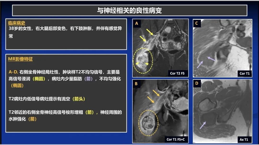 影像PPT - 【PPT】除了神经鞘瘤和神经纤维瘤：与神经相关的良性和恶性病变综述-15