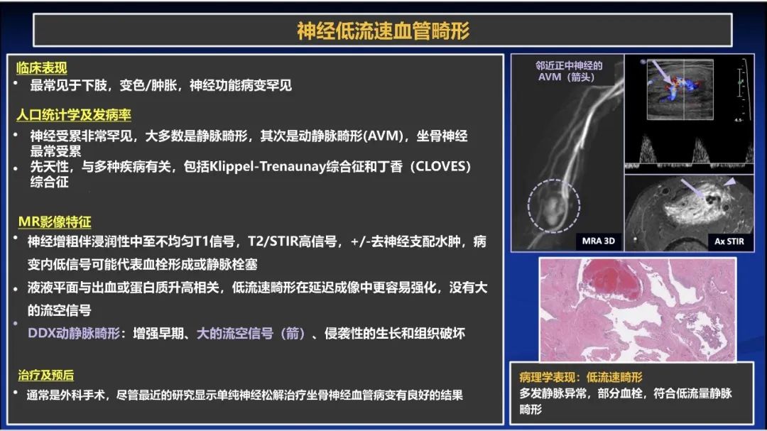 影像PPT - 【PPT】除了神经鞘瘤和神经纤维瘤：与神经相关的良性和恶性病变综述-17