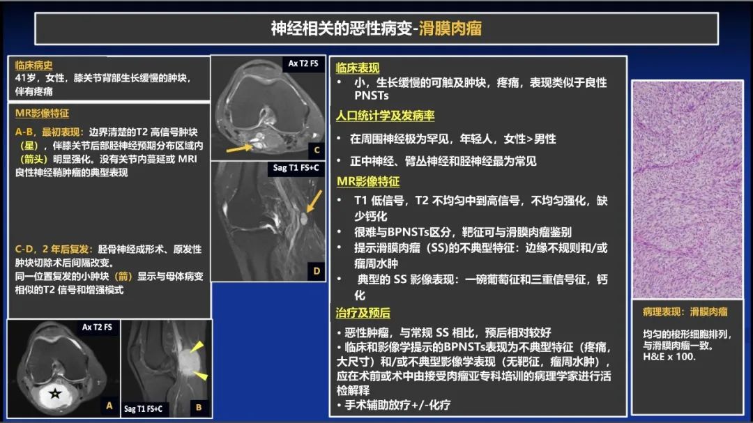 影像PPT - 【PPT】除了神经鞘瘤和神经纤维瘤：与神经相关的良性和恶性病变综述-19