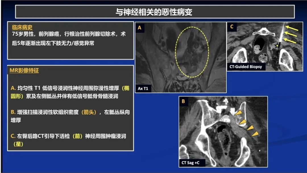 影像PPT - 【PPT】除了神经鞘瘤和神经纤维瘤：与神经相关的良性和恶性病变综述-21