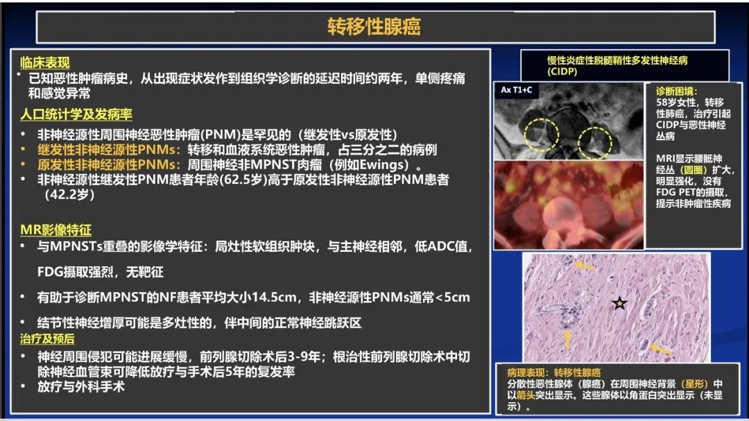 影像PPT - 【PPT】除了神经鞘瘤和神经纤维瘤：与神经相关的良性和恶性病变综述-23