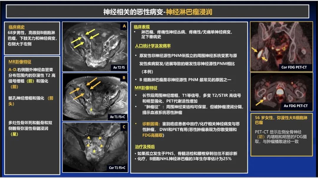 影像PPT - 【PPT】除了神经鞘瘤和神经纤维瘤：与神经相关的良性和恶性病变综述-25