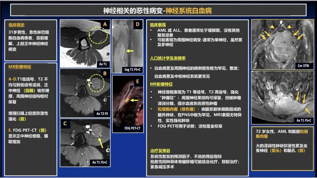 影像PPT - 【PPT】除了神经鞘瘤和神经纤维瘤：与神经相关的良性和恶性病变综述-27