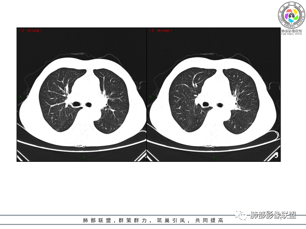 影像PPT - 【病例】胸腺黏液腺癌1例CT影像-5 影像PPT - 【病例】胸腺黏液腺癌1例CT影像-5