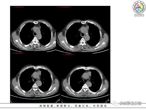 影像PPT - 【病例】胸腺黏液腺癌1例CT影像-6 影像PPT - 【病例】胸腺黏液腺癌1例CT影像-6