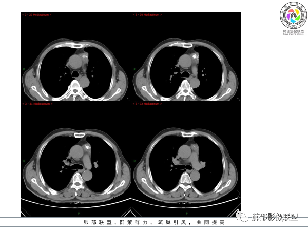 影像PPT - 【病例】胸腺黏液腺癌1例CT影像-7 影像PPT - 【病例】胸腺黏液腺癌1例CT影像-7
