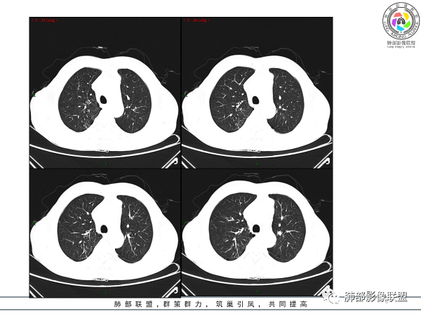 影像PPT - 【病例】胸腺黏液腺癌1例CT影像-3 影像PPT - 【病例】胸腺黏液腺癌1例CT影像-3