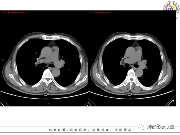 影像PPT - 【病例】胸腺黏液腺癌1例CT影像-8 影像PPT - 【病例】胸腺黏液腺癌1例CT影像-8