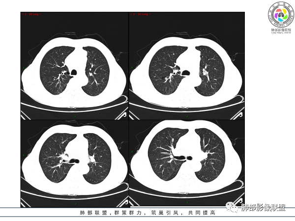 影像PPT - 【病例】胸腺黏液腺癌1例CT影像-4 影像PPT - 【病例】胸腺黏液腺癌1例CT影像-4