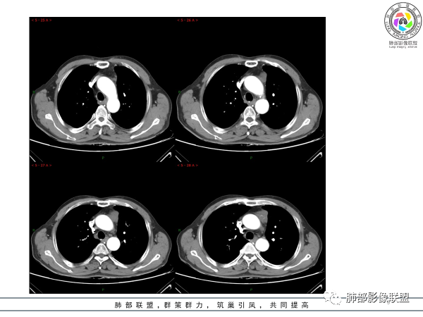影像PPT - 【病例】胸腺黏液腺癌1例CT影像-9 影像PPT - 【病例】胸腺黏液腺癌1例CT影像-9