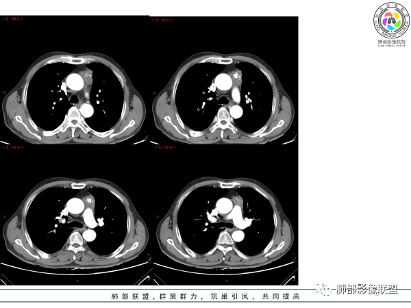 影像PPT - 【病例】胸腺黏液腺癌1例CT影像-10 影像PPT - 【病例】胸腺黏液腺癌1例CT影像-10