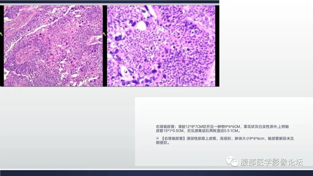 影像PPT - 【病例】肾实质浸润性尿路上皮癌1例CT表现及鉴别诊断-4 影像PPT - 【病例】肾实质浸润性尿路上皮癌1例CT表现及鉴别诊断-4