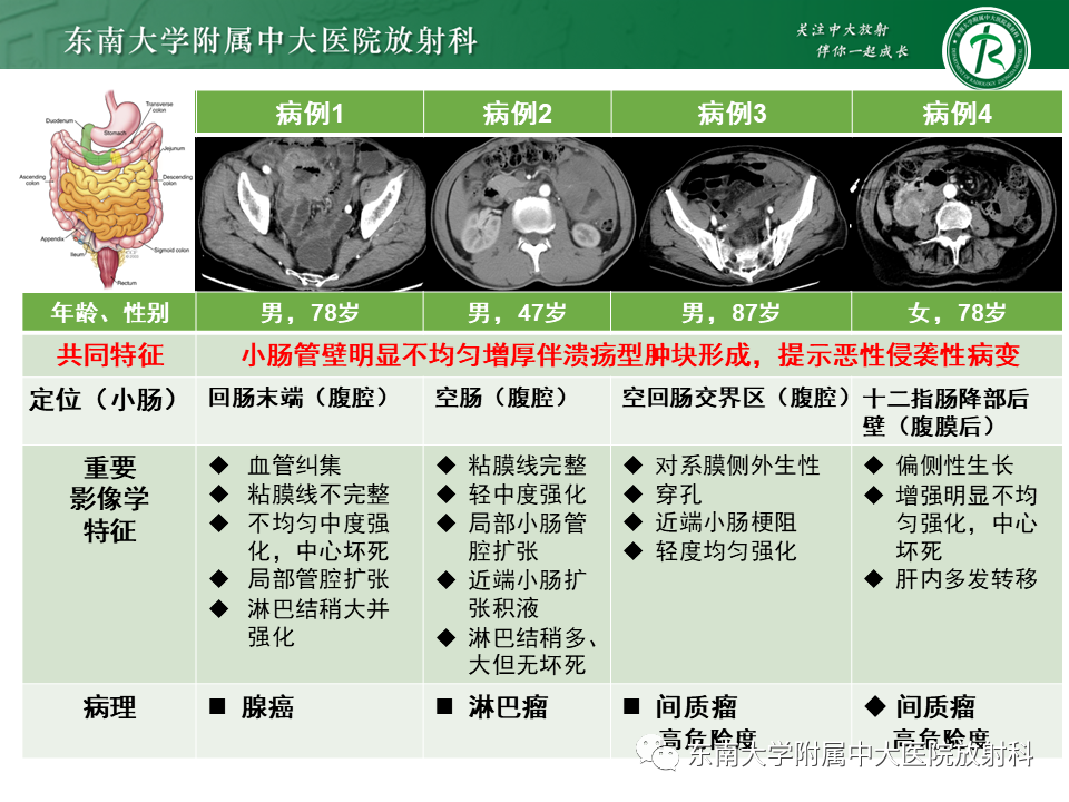 影像PPT - 【PPT】病例讨论：小肠恶性肿瘤-7