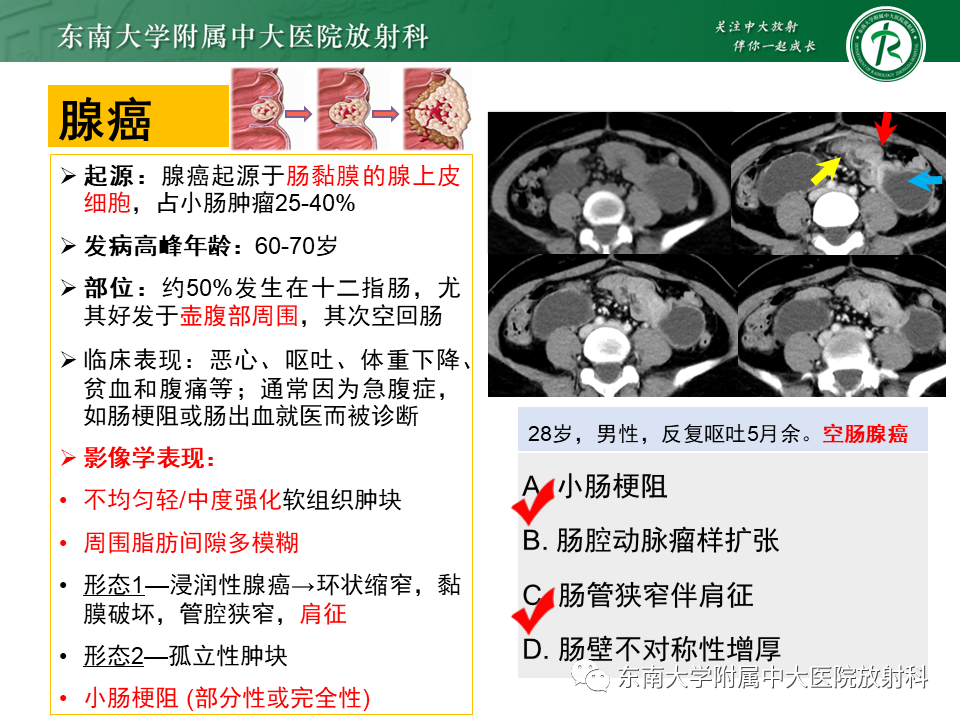 影像PPT - 【PPT】病例讨论：小肠恶性肿瘤-39