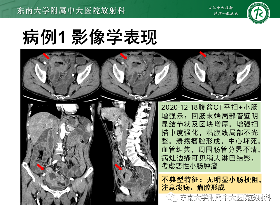影像PPT - 【PPT】病例讨论：小肠恶性肿瘤-15