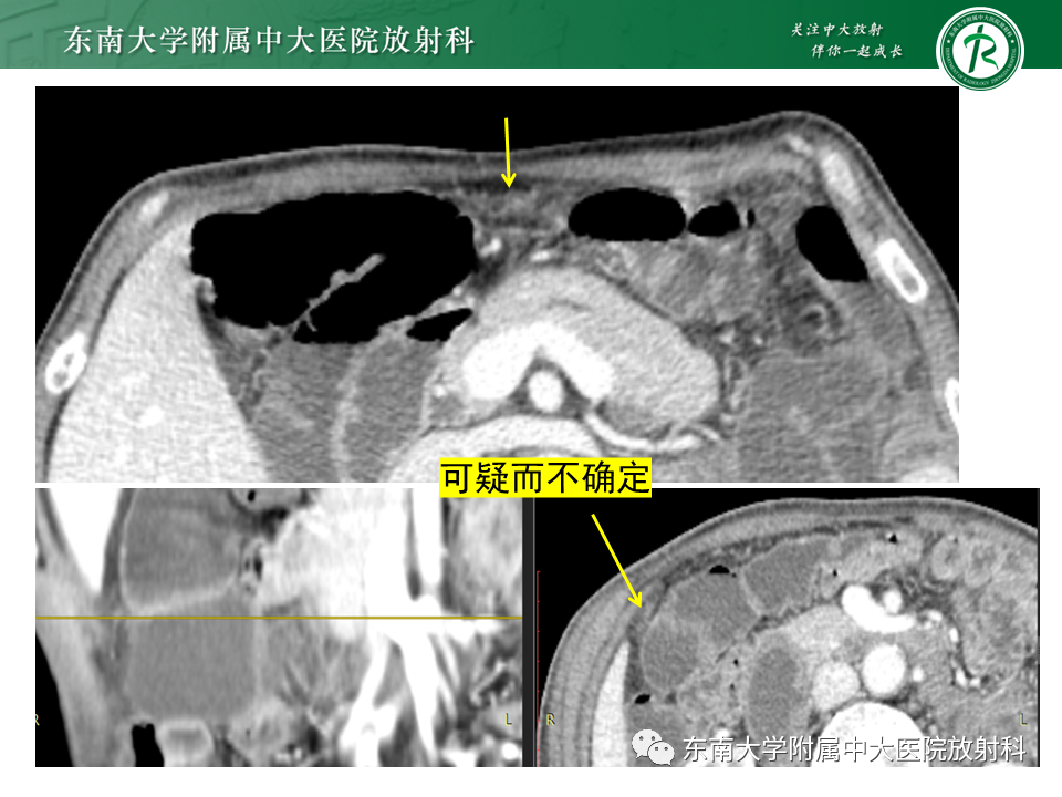 影像PPT - 【PPT】病例讨论：小肠恶性肿瘤-18