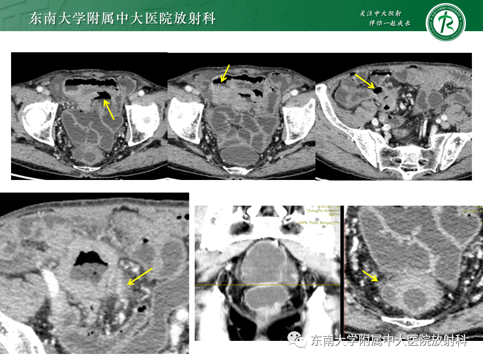 影像PPT - 【PPT】病例讨论：小肠恶性肿瘤-17