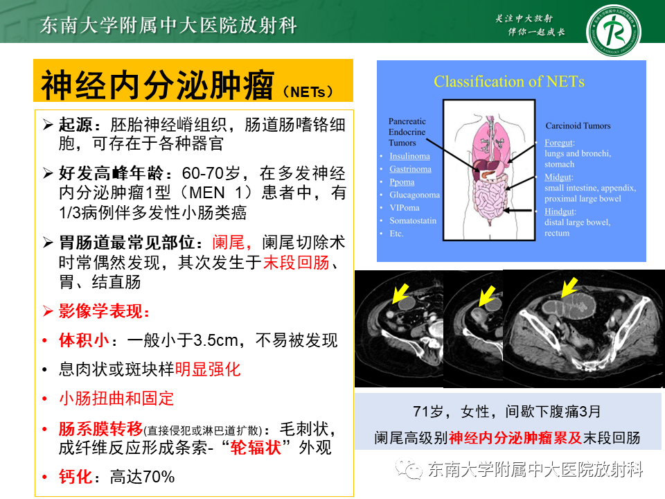 影像PPT - 【PPT】病例讨论：小肠恶性肿瘤-47
