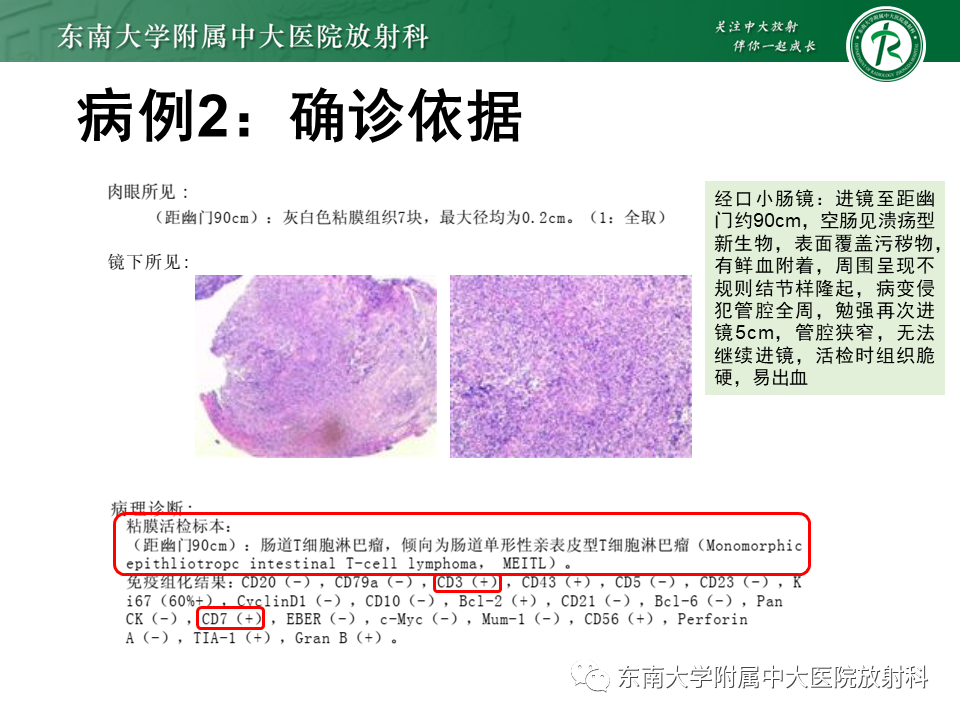 影像PPT - 【PPT】病例讨论：小肠恶性肿瘤-23