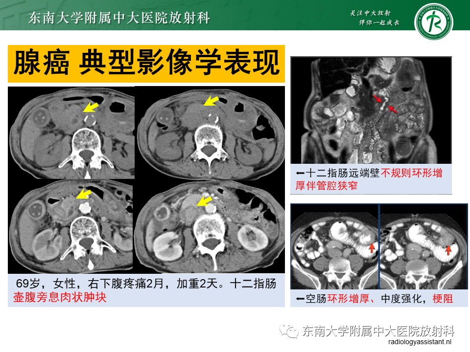影像PPT - 【PPT】病例讨论：小肠恶性肿瘤-40