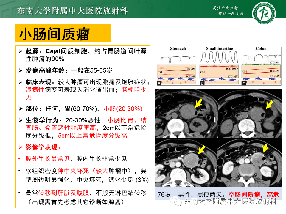 影像PPT - 【PPT】病例讨论：小肠恶性肿瘤-44