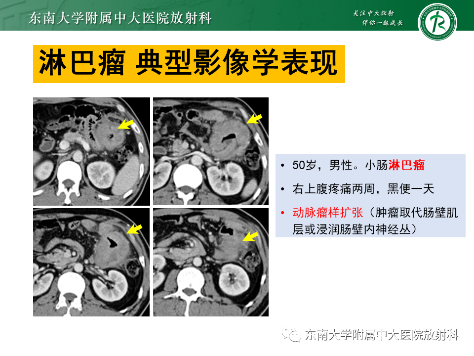 影像PPT - 【PPT】病例讨论：小肠恶性肿瘤-42